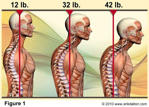 Chiropractor Evergreen CO Poor Posture